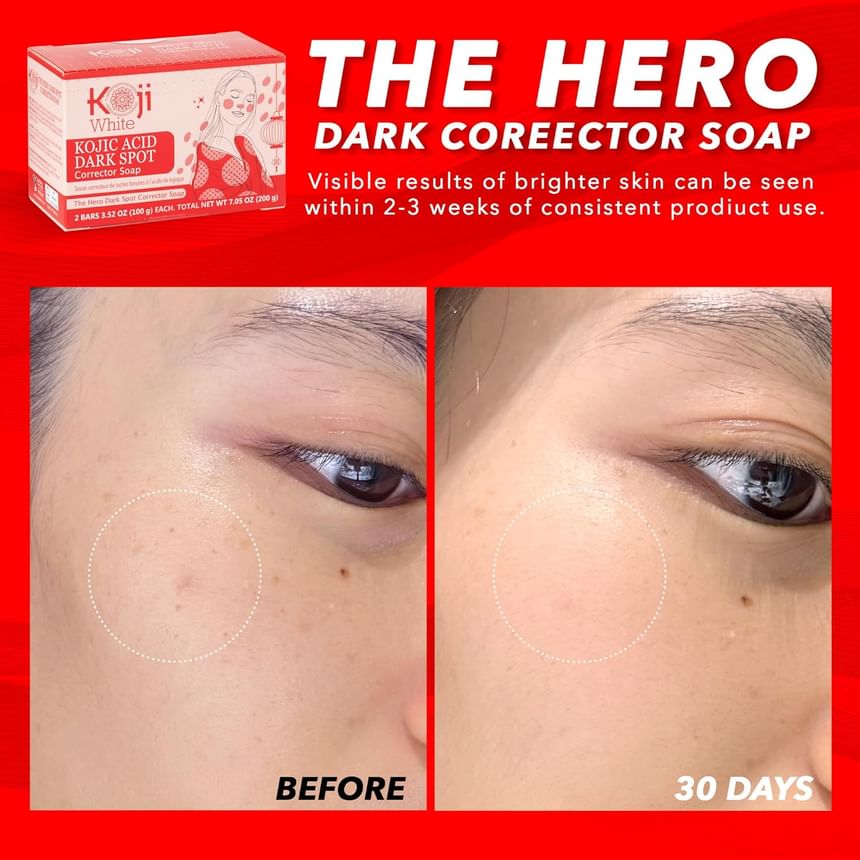 Kojic Acid Dark Spot Corrector Soap