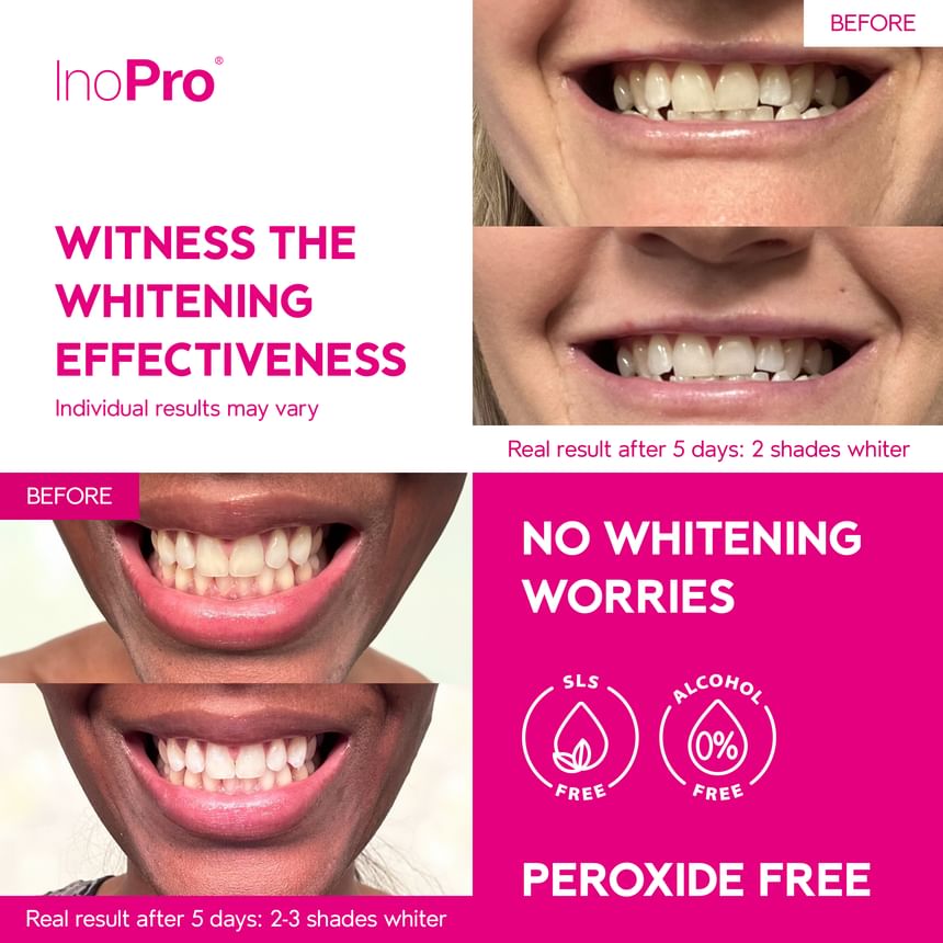 Innovative Whitening Strips